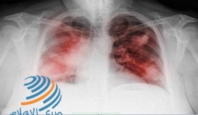 ثلاث علامات تحذيرية غير معتادة قد تكشف الإصابة بسرطان الرئة