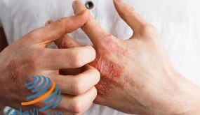 الأمراض الجلدية الأكثر شيوعاً في الصيف